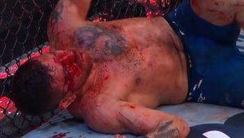 Jim Miller dévoile les blessures subies à l'UFC 300, dont 23 points de suture pour refermer une horrible coupure